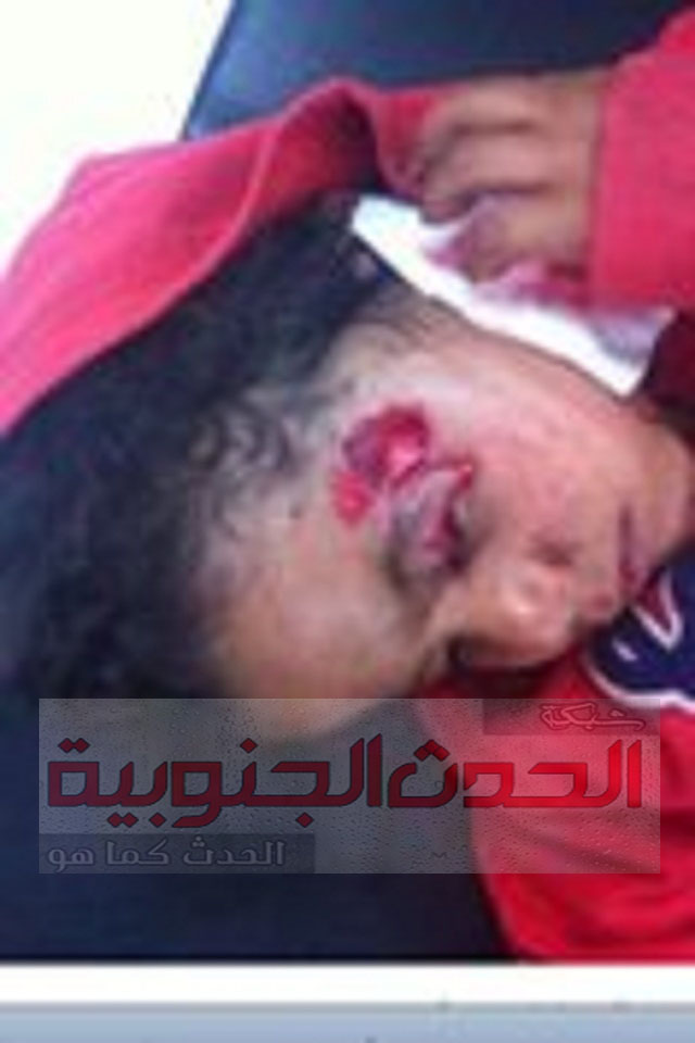 الكلاب المسـعورة تفترس طفل في مديرية الشعيب والأهالي يناشدون الجهات المسئولة