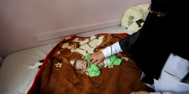 صور مروعة.. سوء التغذية يفتك بالصغار في مستشفى باليمن